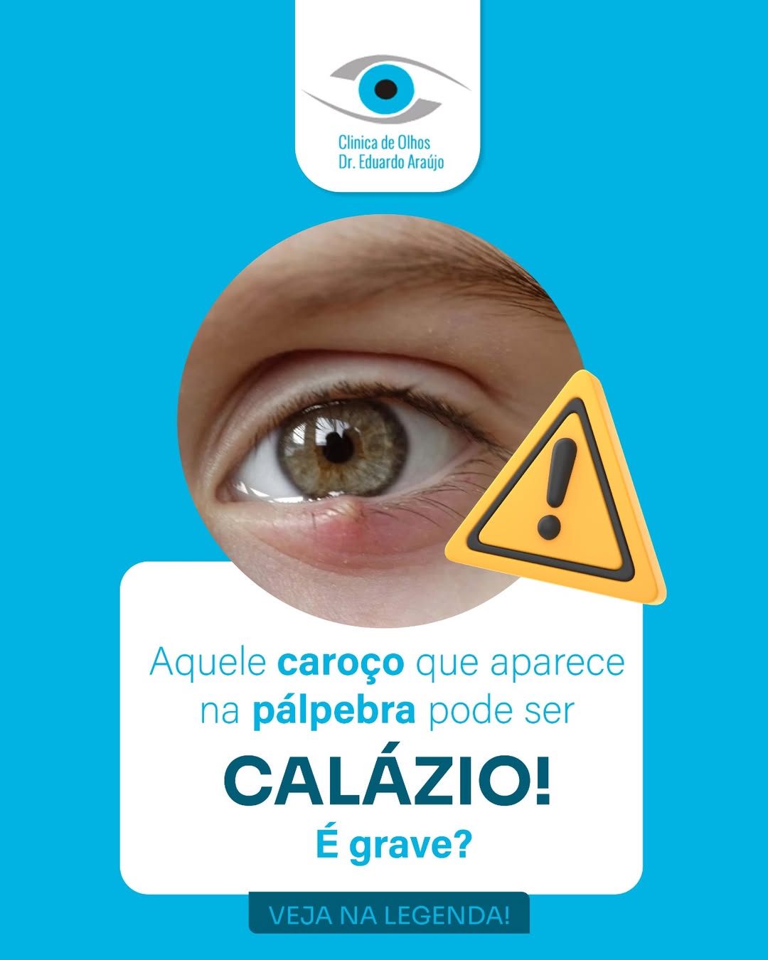 Calázio é grave?