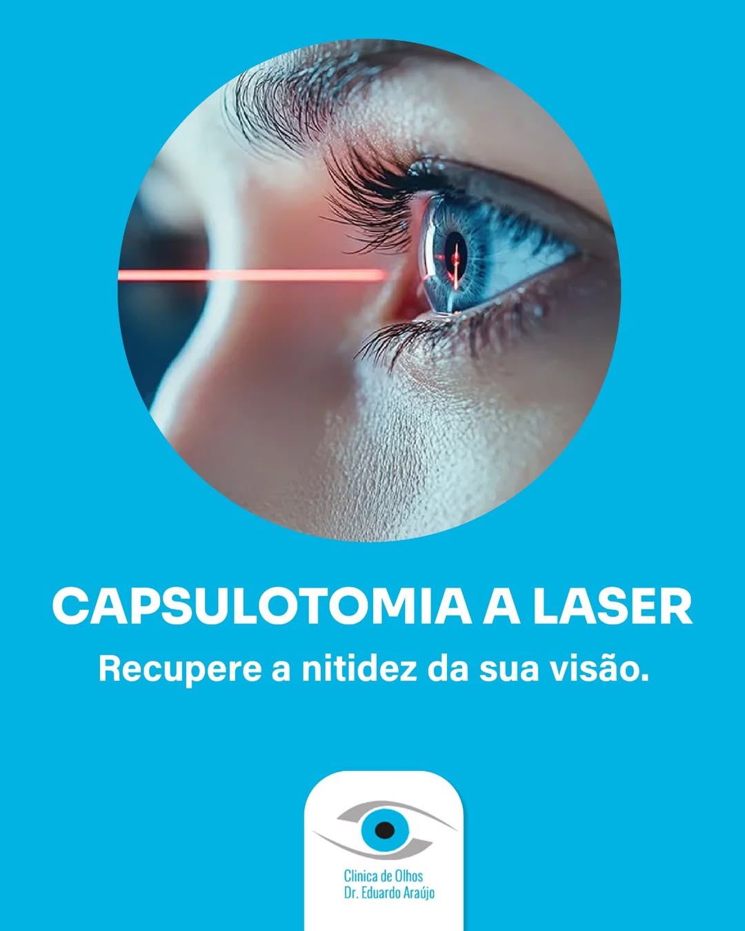 Capsulotomia a laser